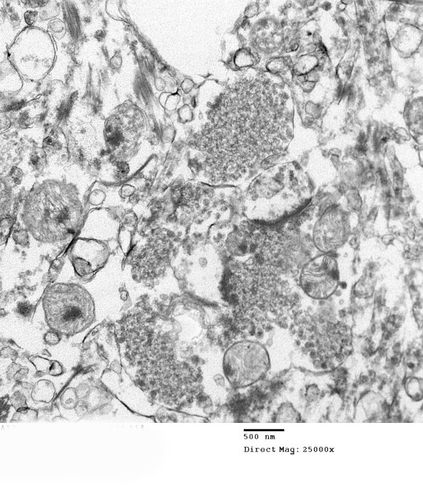 2B4 (Case 2) Alzheimer's Dz_126 - Copy