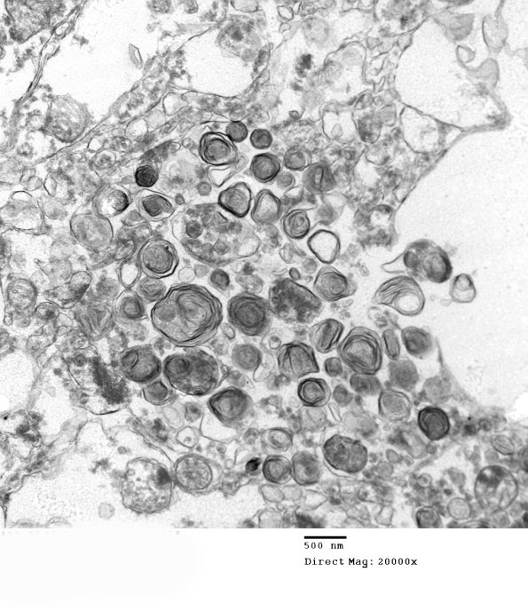 2B5 (Case 2) Alzheimer's Dz_119 - Copy