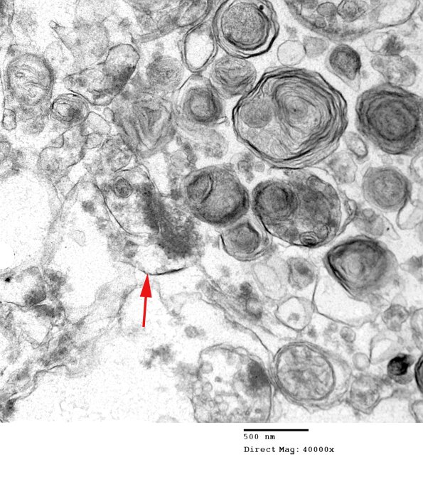 2B6 (Case 2) Alzheimer's Dz_120 copy - Copy A