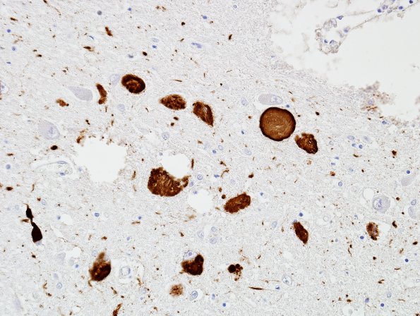 3B2 AD L11 Pons Raphe PHF1 3.jpg