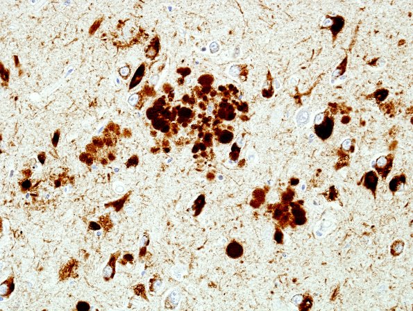 3E7 ADL5 Hippocampus area A PHF1 1.jpg