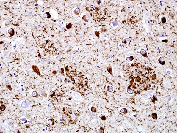 3E8 AD PHF1 L5 40X.jpg