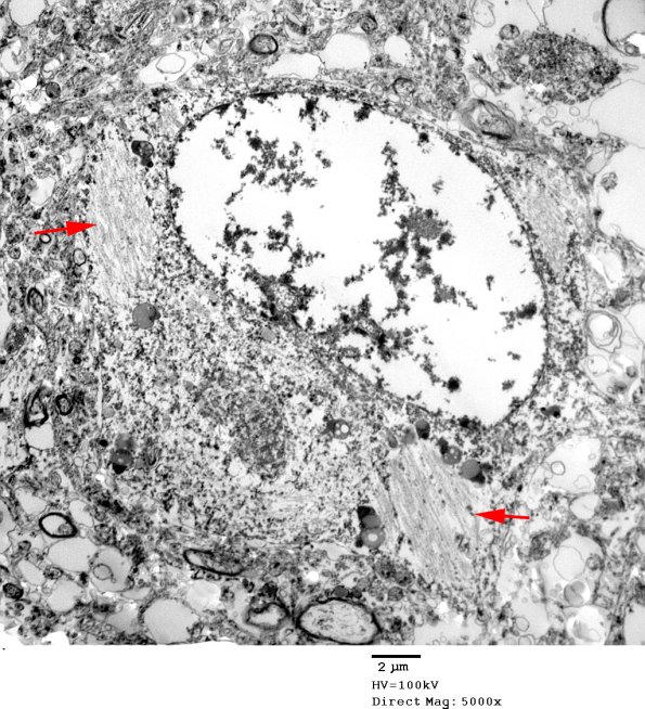 6A1 AD Ultrastructure EM 075 copy - Copy