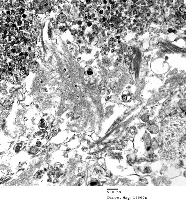 6B2 Alzheimer's Dz plaque EM 136 - Copy