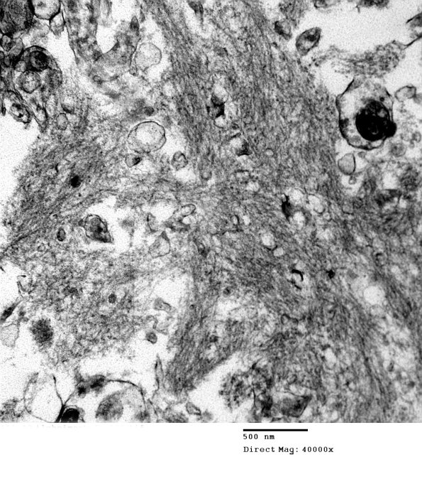 6B3 Alzheimer's Dz plaque EM 137 - Copy