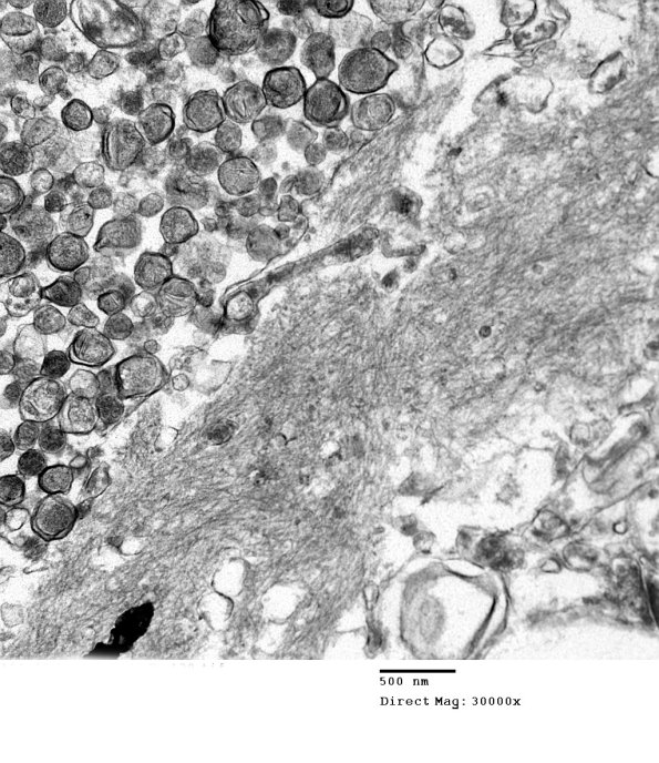 6B4 Alzheimer's Dz plaque EM 139 - Copy