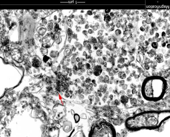 6E1 AD Neuritic Plaque EM 23 copy - Copy