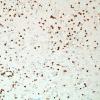 1E1-Anti-NMDAR-Hu-CRMP5-Case-1-N2-CD3-1.jpg