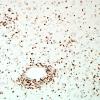 1E3-Anti-NMDAR-Hu-CRMP5-Case-1-N2-CD3-3.jpg