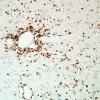 1E4-Anti-NMDAR-Hu-CRMP5-Case-1-N2-CD3-2.jpg