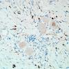 1H1-Anti-NMDAR-Case-1-N19-CD3-2.jpg