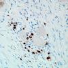 1H10-Anti-NMDAR-Case-1-CD8-4.jpg
