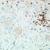1H2-Anti-NMDAR-Case-1-N19-CD3-7.jpg
