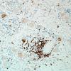 1H3-Anti-NMDAR-Case-1-N19-CD3-1.jpg