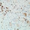 1H4-Anti-NMDAR-Case-1-N19-CD3-9.jpg