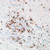 1H5-Anti-NMDAR-Case-1-N19-CD3-5.jpg