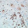 1H6A-Anti-NMDAR-Case-1-N19-CD3-13.jpg