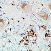 1H6B-Anti-NMDAR-Case-1-N19-CD3-14.jpg