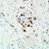 1H8-Anti-NMDAR-Case-1-N19-CD3-15.jpg