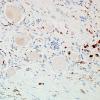 1I5-Anti-NMDAR-Case-1-CD68-6.jpg
