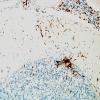 1L7A-Anti-NMDAR-Case-1-N9-CD68-2.jpg