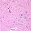 1O2A-Anti-NMDAR-Case-1-N8-ION-H-E-4.jpg