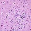 1O2B-Anti-NMDAR-Case-1-N8-ION-H-E-3.jpg