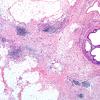 2A2A-NMDAR-encephalitis-Case-2-H-E-4X-2.jpg