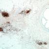 2B1A-NMDAR-encephalitis-Case-2-CD3-4X.jpg