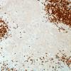 2B1B-NMDAR-encephalitis-Case-2-CD3-20X-1.jpg