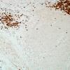 2B1C-NMDAR-encephalitis-Case-2-CD3-20X-4.jpg