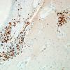 2B2-NMDAR-encephalitis-Case-2-CD3-20X-2.jpg
