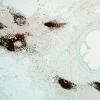 2C1A-NMDAR-encephalitis-Case-2-CD20-4x.jpg