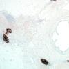 2C2A-NMDAR-encephalitis-Case-2-CD21-4X-1.jpg