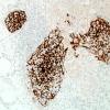 2C2B-NMDAR-encephalitis-Case-2-CD21-20X-1.jpg