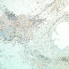 2D1A-NMDAR-encephalitis-Case-2-CD163-4x.jpg