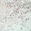 2D2-NMDAR-encephalitis-Case-2-CD163-20X-6.jpg