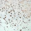 2D3-NMDAR-encephalitis-Case-2-CD163-20X-5.jpg