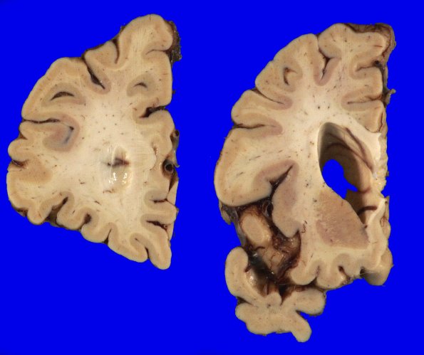 1A2 AGD (Case 1) Gross _2