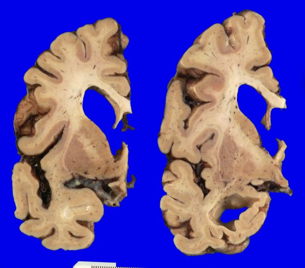 1A3 AGD (Case 1) Gross _3