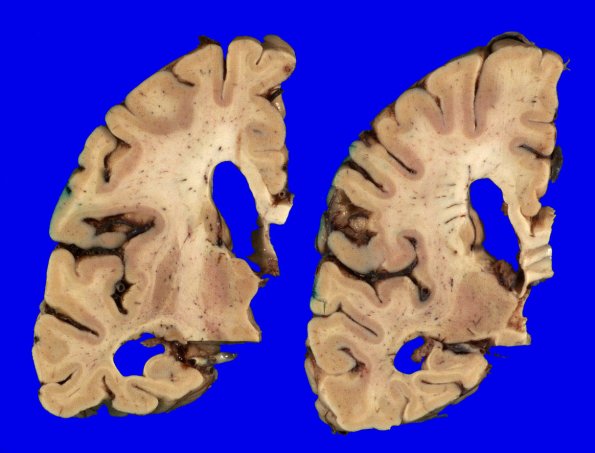 1A4 AGD (Case 1) Gross _4