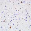 2B1 Argyrophilic Grain Dememtia, mild, no AD Dx (Case 2) L23 PHF 11.jpg