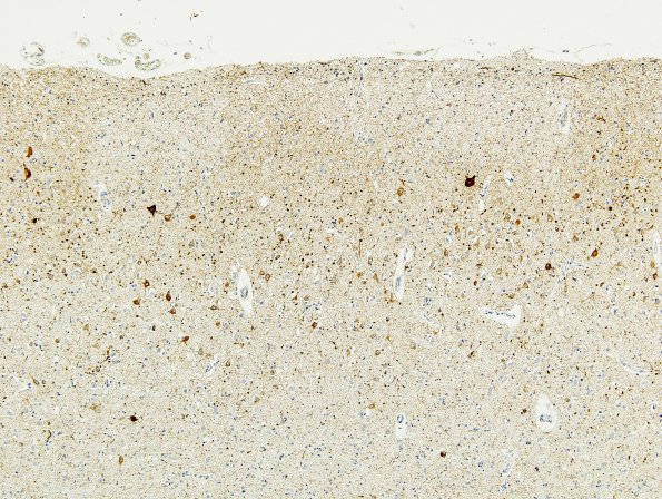 3A2 Argyrophilic Grain Dementia (Case 3) L23 PHF 2.jpg