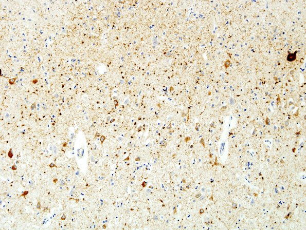 3A3 Argyrophilic Grain Dementia (Case 3) L23 PHF 5.jpg