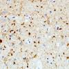 3A5 Argyrophilic Grain Dementia (Case 3) L23 PHF 15.jpg