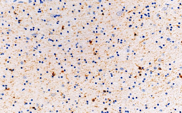 3A6 Argyrophilic Grain Dementia (Case 3) L23 PHF 40X White Matter (WM)