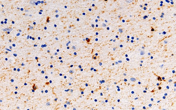 3A7 Argyrophilic Grain Dementia (Case 3) L23 PHF 60X White Matter (WM)