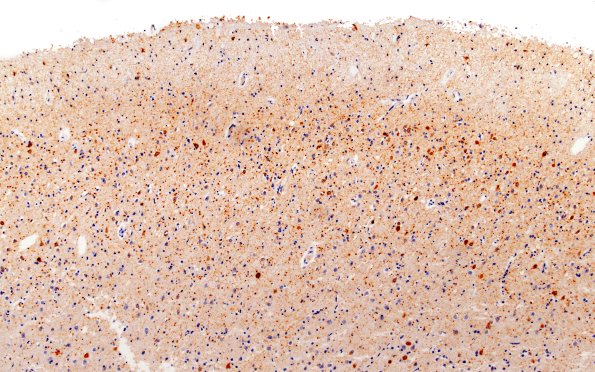 3B1 Argyrophilic Grain Dementia (Case 3) L5 PHF 10X