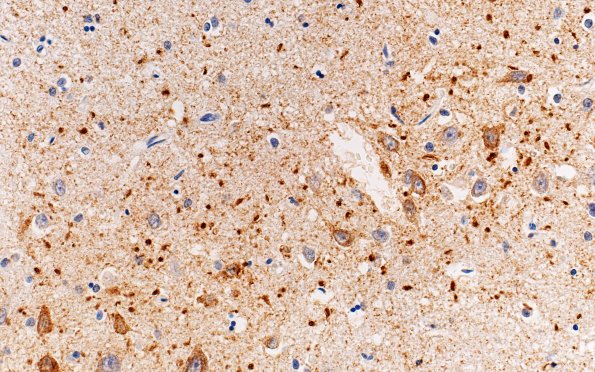 3B2 Argyrophilic Grain Dementia (Case 3) L5 PHF 40X 3