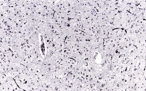 3C1 Argyrophilic Grain Dementia (Case 3) L23 Gallyas 20X